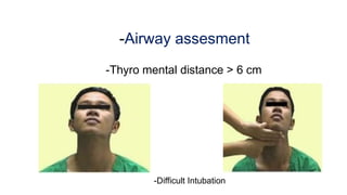 Difficult airway management | PPTX