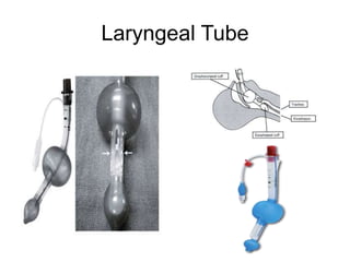 Laryngeal Tube
 