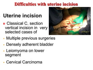 Difficult c section | PPTX