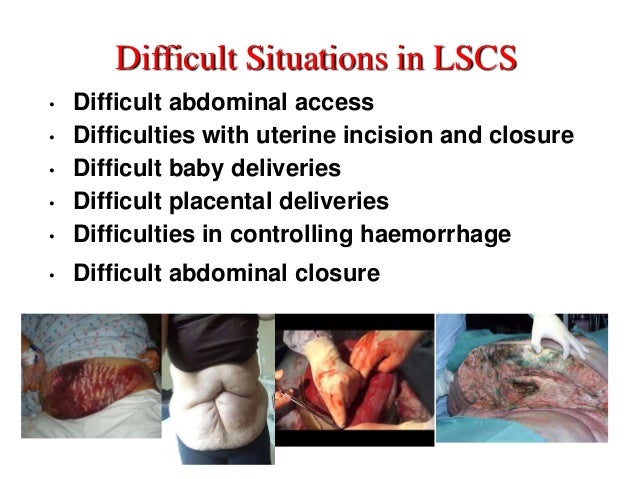 Difficult C Section - 638x479 - jpeg C Section Technique