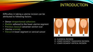 A . CLASSICAL INCISION
B . LOWER SEGMENT TRANSVERSE INCISION
C . LOWER SEGMENT VERTICAL INCISION
Difficulties in taking a uterine incision can be
attributed to following factors:
• Dense intraperitoneal adhesions
• Bladder adhered to the lower uterine segment
• Previous classical caesarean section scar
• Uterine anomaly
• Fibroid in lower segment or cervical cancer
INTRODUCTION
 