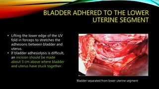 BLADDER ADHERED TO THE LOWER
UTERINE SEGMENT
• Lifting the lower edge of the UV
fold in forceps to stretches the
adhesions between bladder and
uterus.
• If bladder adhesiolysis is difficult,
an incision should be made
about 3 cm above where bladder
and uterus have stuck together.
Bladder separated from lower uterine segment
 