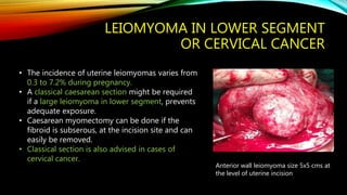 LEIOMYOMA IN LOWER SEGMENT
OR CERVICAL CANCER
• The incidence of uterine leiomyomas varies from
0.3 to 7.2% during pregnancy.
• A classical caesarean section might be required
if a large leiomyoma in lower segment, prevents
adequate exposure.
• Caesarean myomectomy can be done if the
fibroid is subserous, at the incision site and can
easily be removed.
• Classical section is also advised in cases of
cervical cancer.
Anterior wall leiomyoma size 5x5 cms at
the level of uterine incision
 