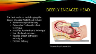 DEEPLY ENGAGED HEAD
The best methods to dislodging the
deeply engaged foetal head include:
• Abdominovaginal delivery
• Patwardhan’s shoulders first
technique
• Modified Patwardhan’s technique
• Use of a head elevators
• Reverse breech extraction
technique
• Forceps delivery
Reverse breech extraction
 