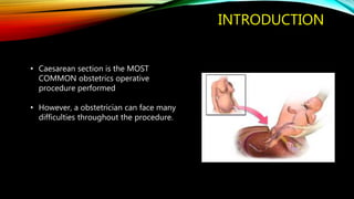 INTRODUCTION
• Caesarean section is the MOST
COMMON obstetrics operative
procedure performed
• However, a obstetrician can face many
difficulties throughout the procedure.
 