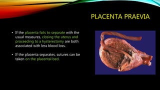 PLACENTA PRAEVIA
• If the placenta fails to separate with the
usual measures, closing the uterus and
proceeding to a hysterectomy are both
associated with less blood loss.
• If the placenta separates, sutures can be
taken on the placental bed.
 