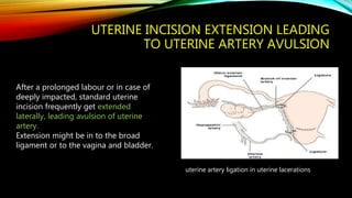 UTERINE INCISION EXTENSION LEADING
TO UTERINE ARTERY AVULSION
After a prolonged labour or in case of
deeply impacted, standard uterine
incision frequently get extended
laterally, leading avulsion of uterine
artery.
Extension might be in to the broad
ligament or to the vagina and bladder.
uterine artery ligation in uterine lacerations
 