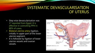 SYSTEMATIC DEVASCULARISATION
OF UTERUS
• Step wise devascularisation was
1st reported from Egypt. It is
effective in controlling PPH in
80% of cases.
• Bilateral uterine artery ligation,
initially in upper part of the lower
uterine segment.
• It is followed by ligation of lower
uterine vessels and ovarian
vessels.
 