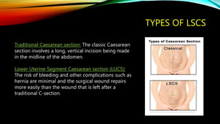 TYPES OF LSCS
Traditional Caesarean section: The classic Caesarean
section involves a long, vertical incision being made
in the midline of the abdomen.
Lower Uterine Segment Caesarean section (LUCS):
The risk of bleeding and other complications such as
hernia are minimal and the surgical wound repairs
more easily than the wound that is left after a
traditional C-section.
 