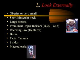 L: Look Externally
• Obesity or very small.
• Short Muscular neck
• Large breasts
• Prominent Upper Incisors (Buck Teeth)
• Receding Jaw (Dentures)
• Burns
• Facial Trauma
• Stridor
• Macroglossia
 