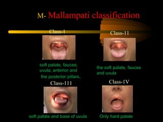 M- Mallampati classification
Class-1 Class-11
Class-111 Class-1V
soft palate, fauces;
uvula, anterior and
the posterior pillars.
the soft palate, fauces
and uvula
soft palate and base of uvula Only hard palate
 