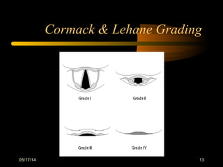 Cormack & Lehane Grading
05/17/14 13
 