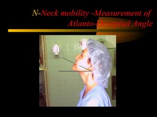 N-Neck mobility -Measurement of
Atlanto-Occepital Angle
 