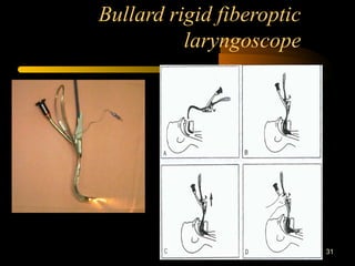 Bullard rigid fiberoptic
laryngoscope
31
 