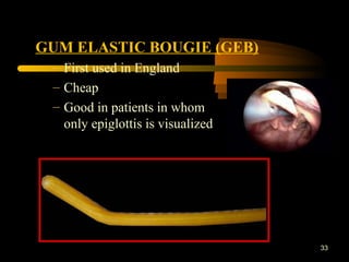33
GUM ELASTIC BOUGIE (GEB)
– First used in England
– Cheap
– Good in patients in whom
only epiglottis is visualized
 