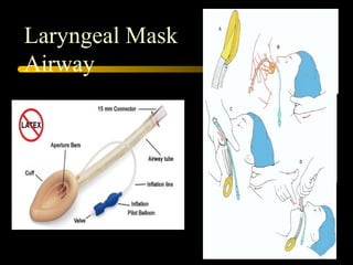 Laryngeal Mask
Airway
 