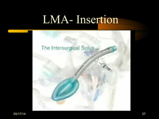 05/17/14 37
LMA- Insertion
 