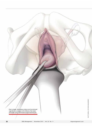 scott bodell for obg Management

Even a large, myomatous uterus can be removed
vaginally by a surgeon who follows a few basic
principles using well-honed surgical techniques.

32

OBG Management | November 2010 | Vol. 22 No. 11

obgmanagement.com

 