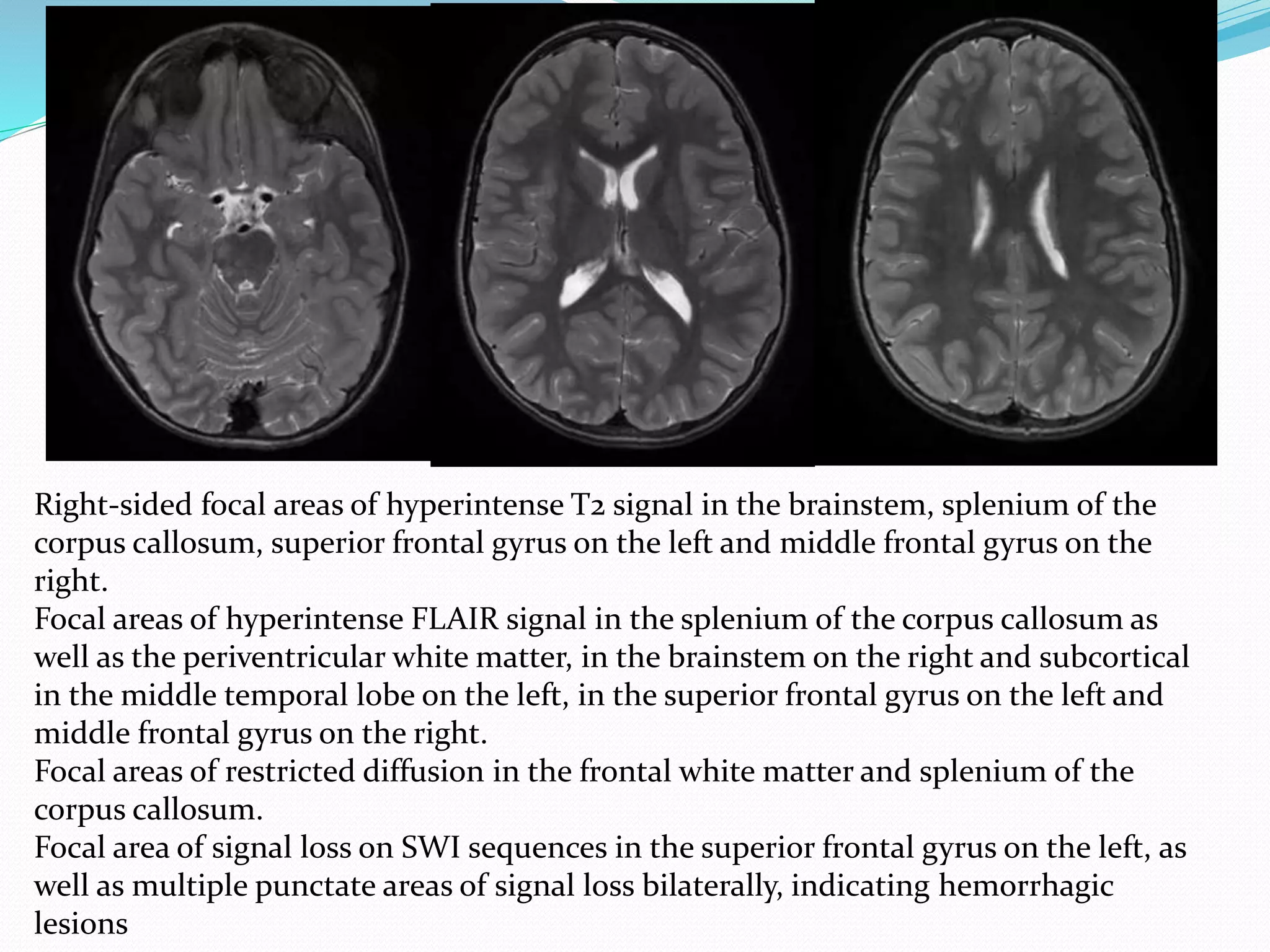 Right-sided focal areas of hyperintense T2 signal in the brainstem, splenium of the
corpus callosum, superior frontal gyrus on the left and middle frontal gyrus on the
right.
Focal areas of hyperintense FLAIR signal in the splenium of the corpus callosum as
well as the periventricular white matter, in the brainstem on the right and subcortical
in the middle temporal lobe on the left, in the superior frontal gyrus on the left and
middle frontal gyrus on the right.
Focal areas of restricted diffusion in the frontal white matter and splenium of the
corpus callosum.
Focal area of signal loss on SWI sequences in the superior frontal gyrus on the left, as
well as multiple punctate areas of signal loss bilaterally, indicating hemorrhagic
lesions
 