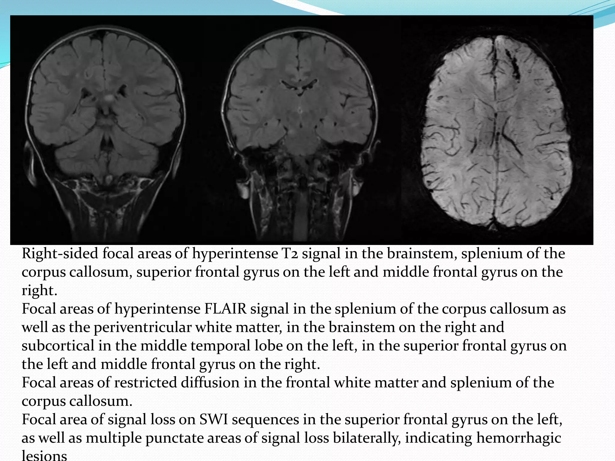 MRI
Right-sided focal areas of hyperintense T2 signal in the brainstem, splenium of the
corpus callosum, superior frontal gyrus on the left and middle frontal gyrus on the
right.
Focal areas of hyperintense FLAIR signal in the splenium of the corpus callosum as
well as the periventricular white matter, in the brainstem on the right and
subcortical in the middle temporal lobe on the left, in the superior frontal gyrus on
the left and middle frontal gyrus on the right.
Focal areas of restricted diffusion in the frontal white matter and splenium of the
corpus callosum.
Focal area of signal loss on SWI sequences in the superior frontal gyrus on the left,
as well as multiple punctate areas of signal loss bilaterally, indicating hemorrhagic
 