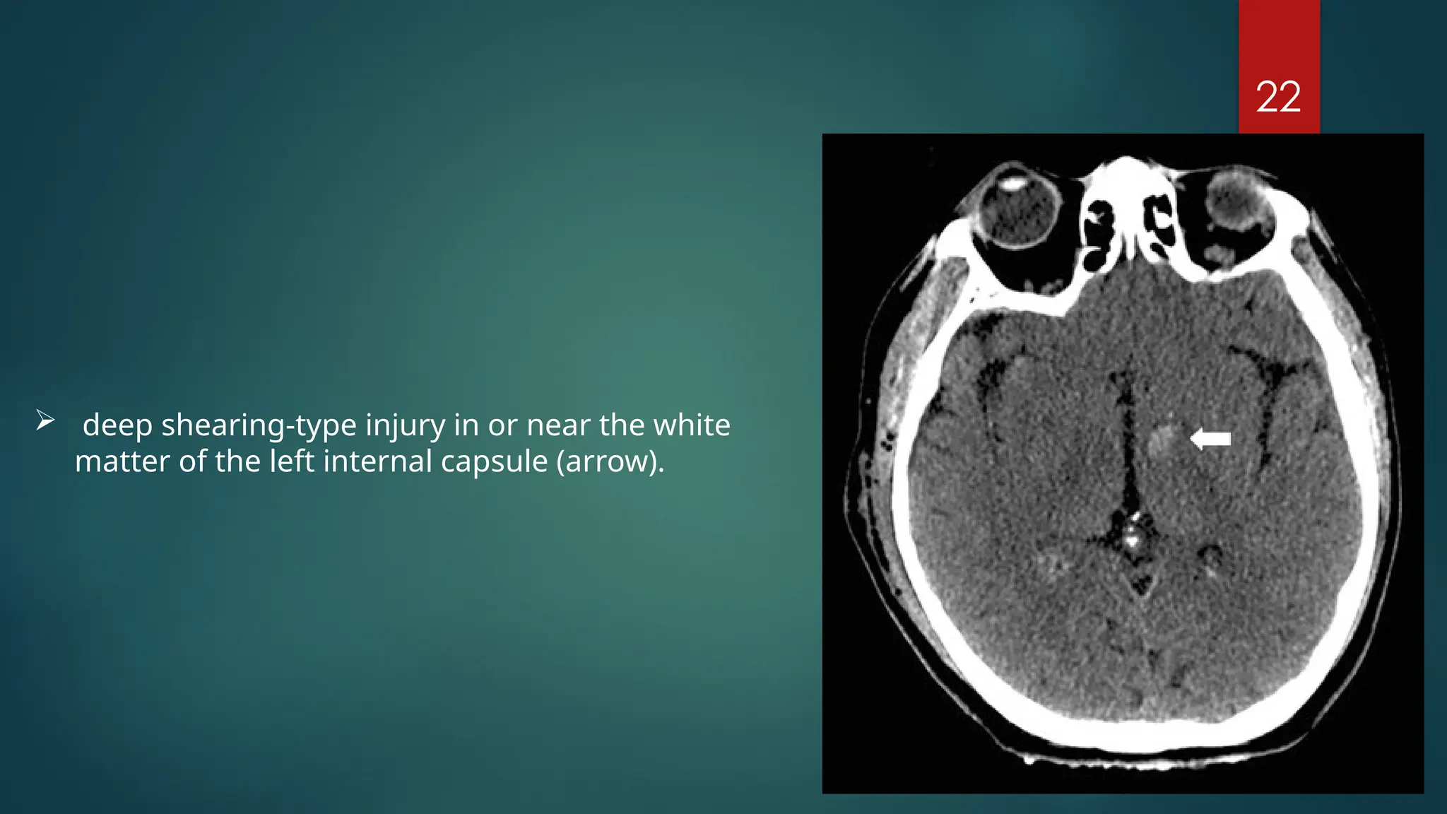 08/21/2024
22
 deep shearing-type injury in or near the white
matter of the left internal capsule (arrow).
 