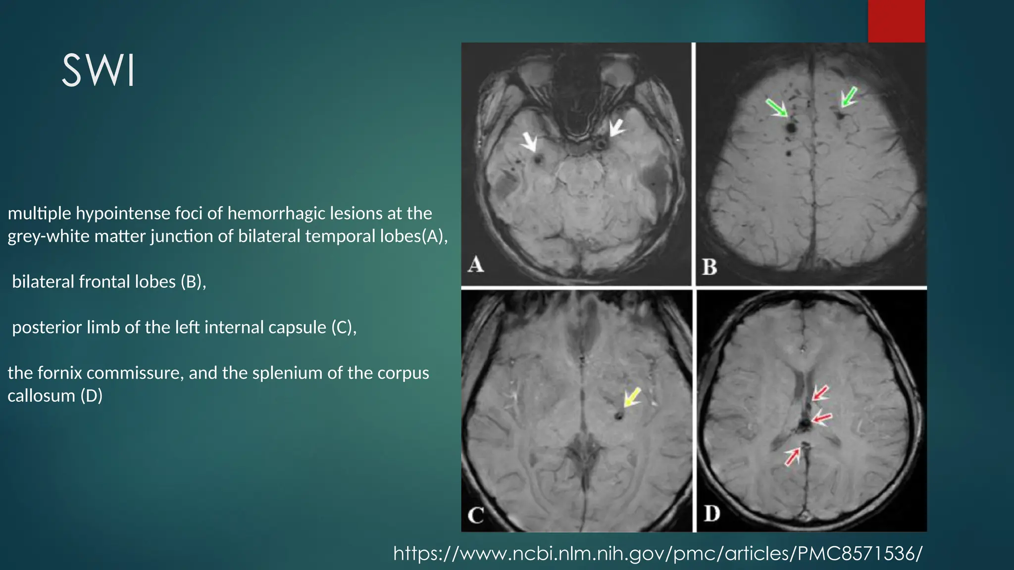 08/21/2024
27
SWI
multiple hypointense foci of hemorrhagic lesions at the
grey-white matter junction of bilateral temporal lobes(A),
bilateral frontal lobes (B),
posterior limb of the left internal capsule (C),
the fornix commissure, and the splenium of the corpus
callosum (D)
https://www.ncbi.nlm.nih.gov/pmc/articles/PMC8571536/
 