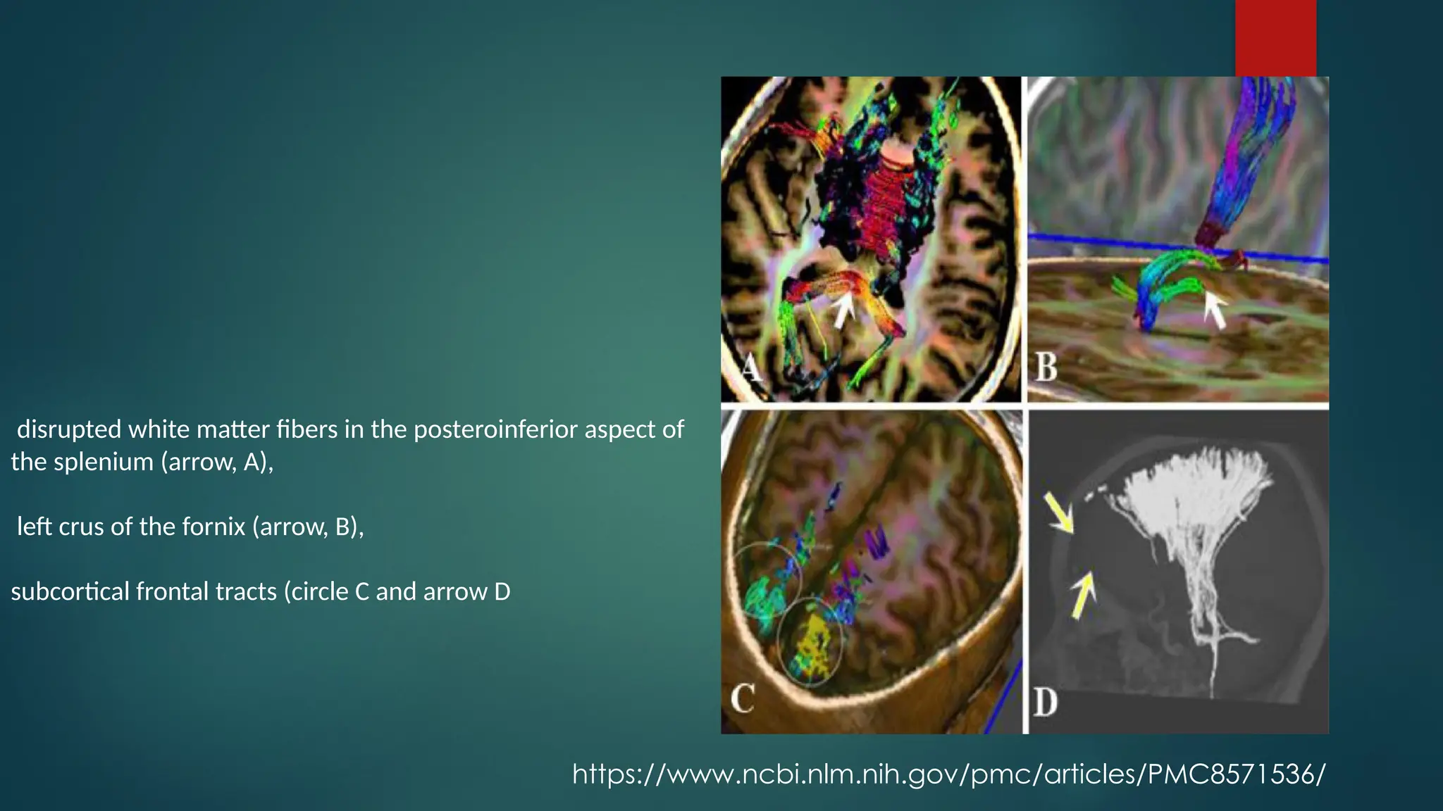 08/21/2024
29
disrupted white matter fibers in the posteroinferior aspect of
the splenium (arrow, A),
left crus of the fornix (arrow, B),
subcortical frontal tracts (circle C and arrow D
https://www.ncbi.nlm.nih.gov/pmc/articles/PMC8571536/
 