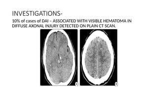 The Clinical and Radiologic Aspects of Diffuse Axonal Injury: A ...