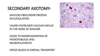 Axotomy The Clinical and Radiologic Aspects of Diffuse Axonal Injury: A ...