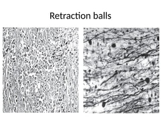 Diffuse Axonal Injury IN ACASE OF ROA TRAFFIC ACCIDENT.pptx