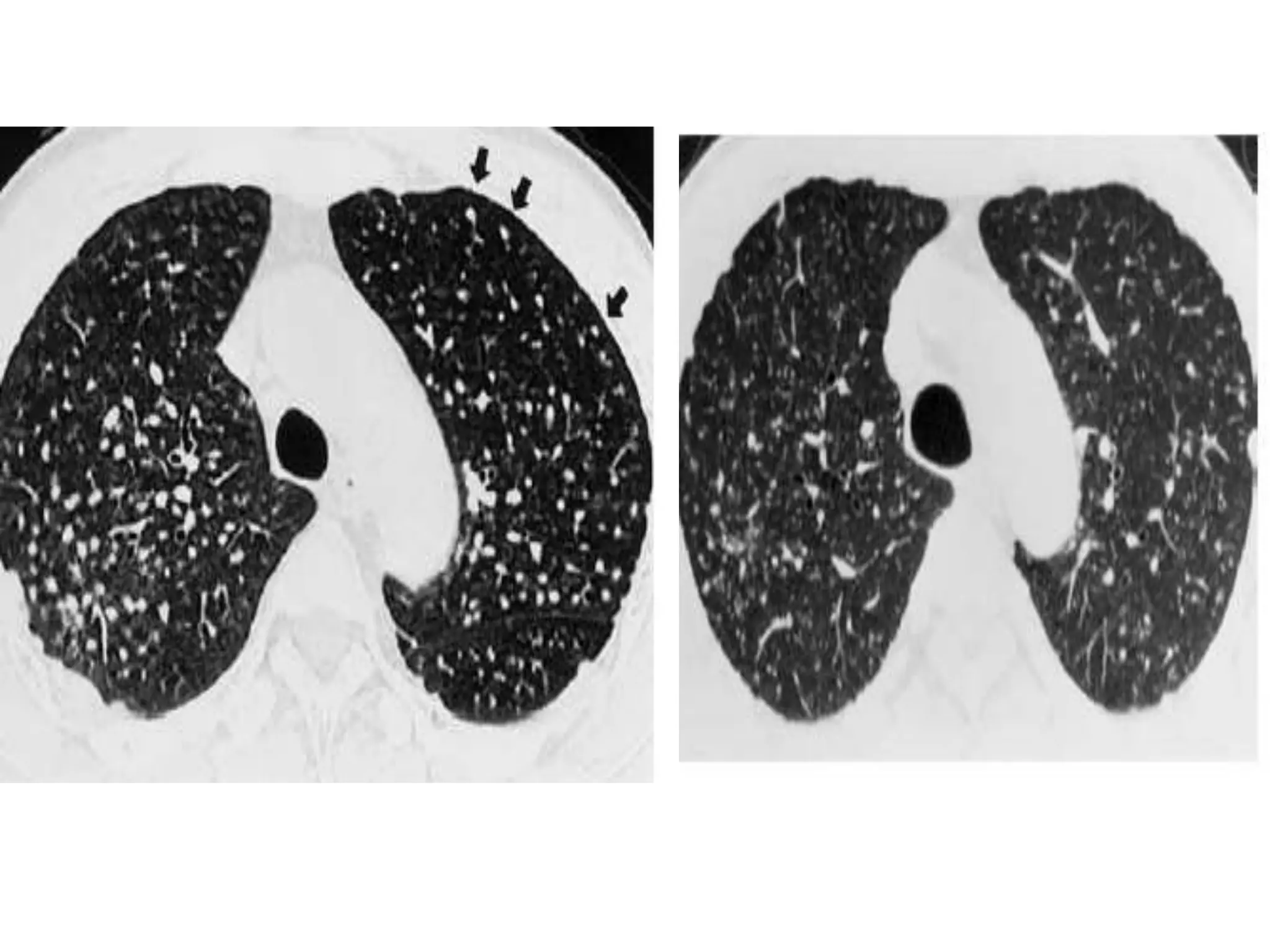 Interstitial lung disease Radiology | PPTX