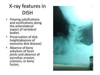 Diffuse idiopathic skeletal hyperostosis | PPTX