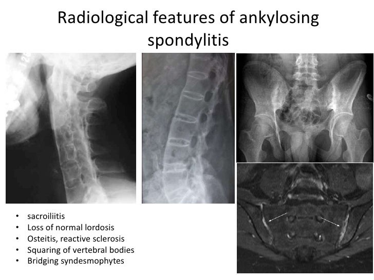 Diffuse idiopathic skeletal hyperostosis