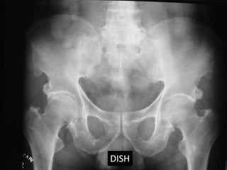 Diffuse idiopathic skeletal hyperostosis | PPTX