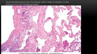 Usual interstitial pneumonia. The fibrosis, which varies in intensity, is more
pronounced in the sub-pleural region
 