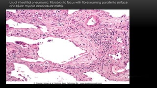 Usual interstitial pneumonia. Fibroblastic focus with fibres running parallel to surface
and bluish myxoid extracellular matrix.
 