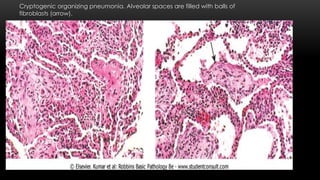 Cryptogenic organizing pneumonia. Alveolar spaces are filled with balls of
fibroblasts (arrow).
 