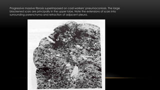 Progressive massive fibrosis superimposed on coal workers' pneumoconiosis. The large
blackened scars are principally in the upper lobe. Note the extensions of scars into
surrounding parenchyma and retraction of adjacent pleura.
 