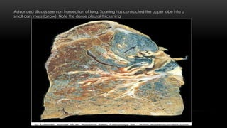 Advanced silicosis seen on transection of lung. Scarring has contracted the upper lobe into a
small dark mass (arrow). Note the dense pleural thickening
 