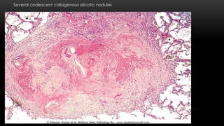 Several coalescent collagenous silicotic nodules
 
