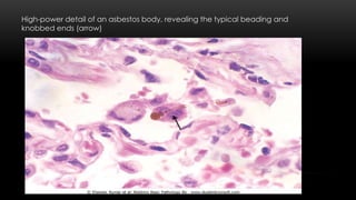 High-power detail of an asbestos body, revealing the typical beading and
knobbed ends (arrow)
 