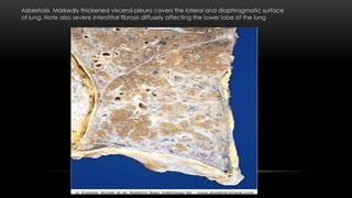 Asbestosis. Markedly thickened visceral pleura covers the lateral and diaphragmatic surface
of lung. Note also severe interstitial fibrosis diffusely affecting the lower lobe of the lung
 