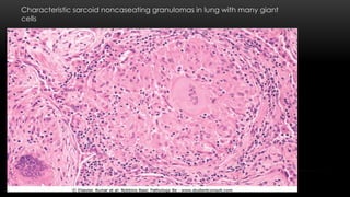 Characteristic sarcoid noncaseating granulomas in lung with many giant
cells
 