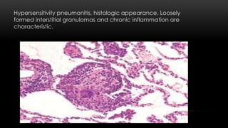 Hypersensitivity pneumonitis, histologic appearance. Loosely
formed interstitial granulomas and chronic inflammation are
characteristic.
 