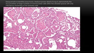 Desquamative interstitial pneumonia. Medium-power detail of lung to demonstrate the
accumulation of large numbers of mononuclear cells within the alveolar spaces with only
mild fibrous thickening of the alveolar walls
 