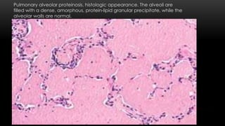 Pulmonary alveolar proteinosis, histologic appearance. The alveoli are
filled with a dense, amorphous, protein-lipid granular precipitate, while the
alveolar walls are normal.
 