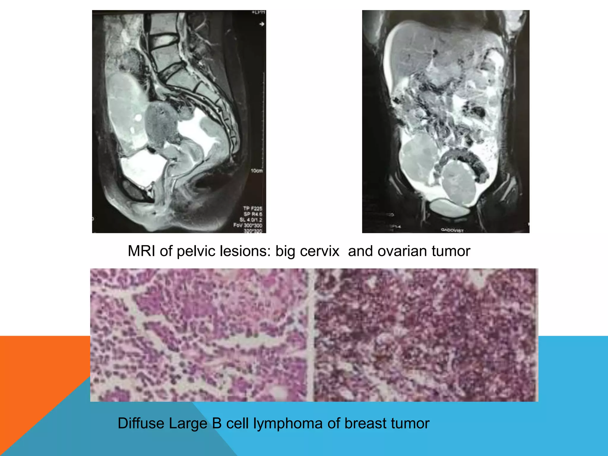 Curated visual reference: Fresh Look at Diffuse Large B Cell Lymphoma And Appearences In Oral Cavity