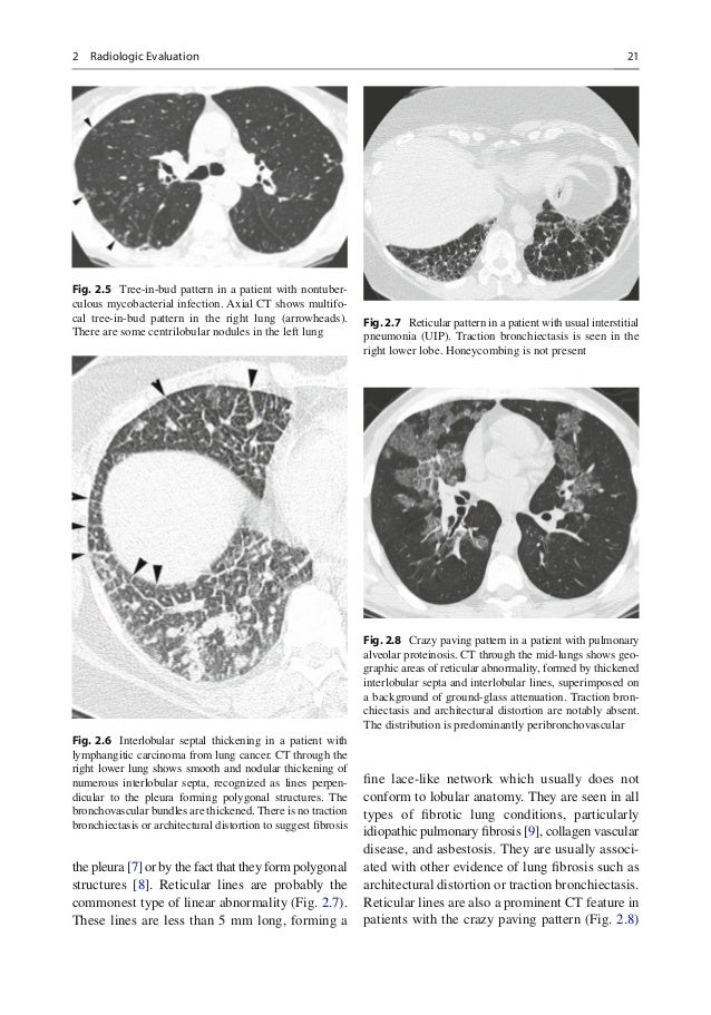 Diffuse lung disease