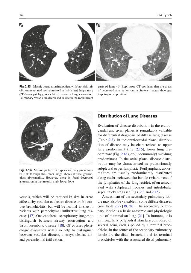 Diffuse lung disease