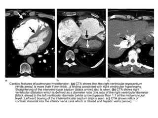 Cardiac features of pulmonary hypertension. (a) CTA shows that the right ventricular myocardium
(white arrow) is more than 4 mm thick , a finding consistent with right ventricular hypertrophy.
Straightening of the interventricular septum (black arrow) also is seen. (b) CTA shows right
ventricular dilatation which is defined as a diameter ratio (the ratio of the right ventricular diameter
[black arrow] to the left ventricular diameter [white arrow]) greater than 1:1 at the midventricular
level , Leftward bowing of the interventricular septum also is seen. (c) CTA shows reflux of
contrast material into the inferior vena cava which is dilated and hepatic veins (arrow)
 